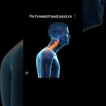 How to Fix Forward Head Posture: Effective Solutions and Exercises